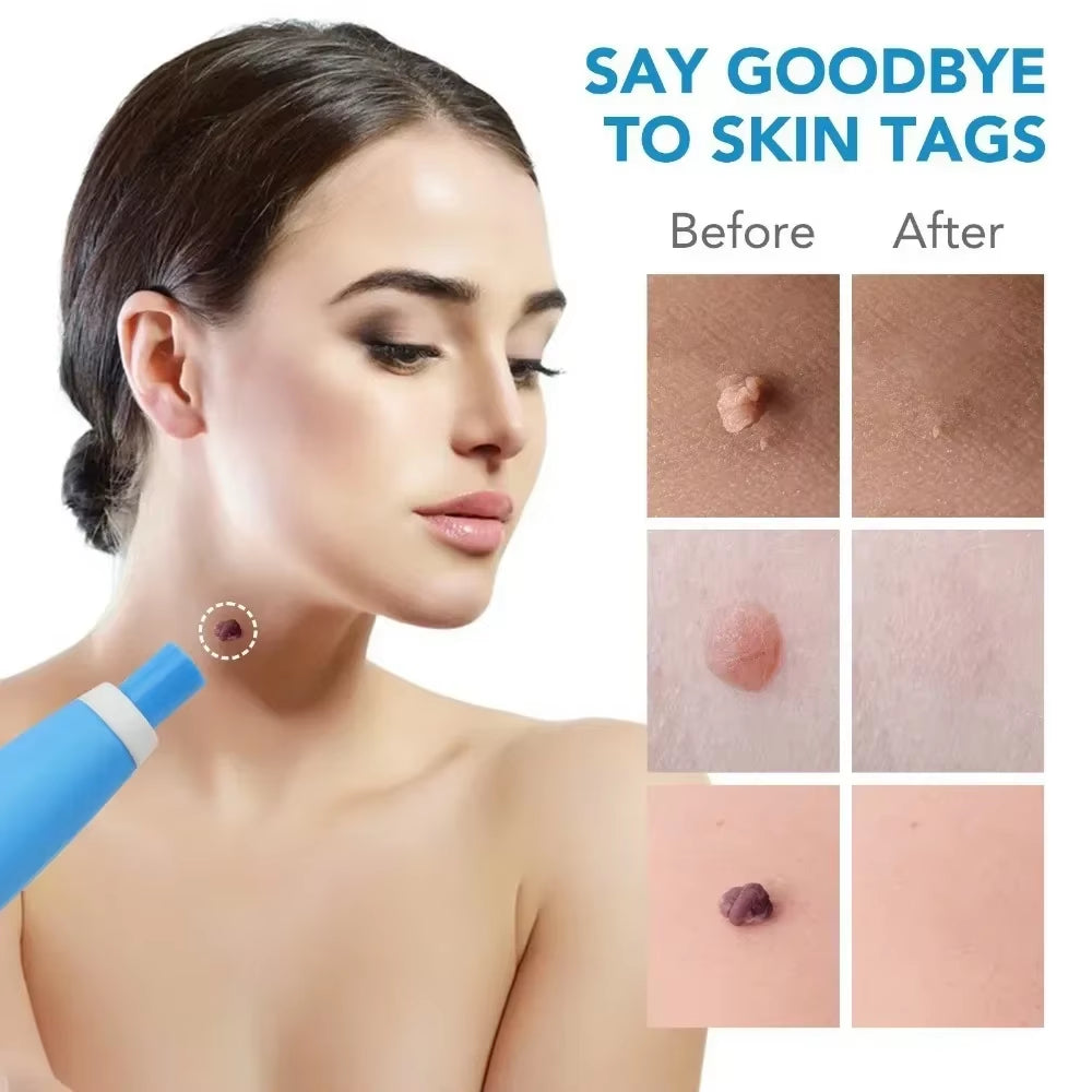 Painless Skin Tag & Mole Remover for Smooth, Glowing Skin"